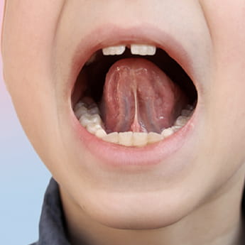 舌の位置の改善