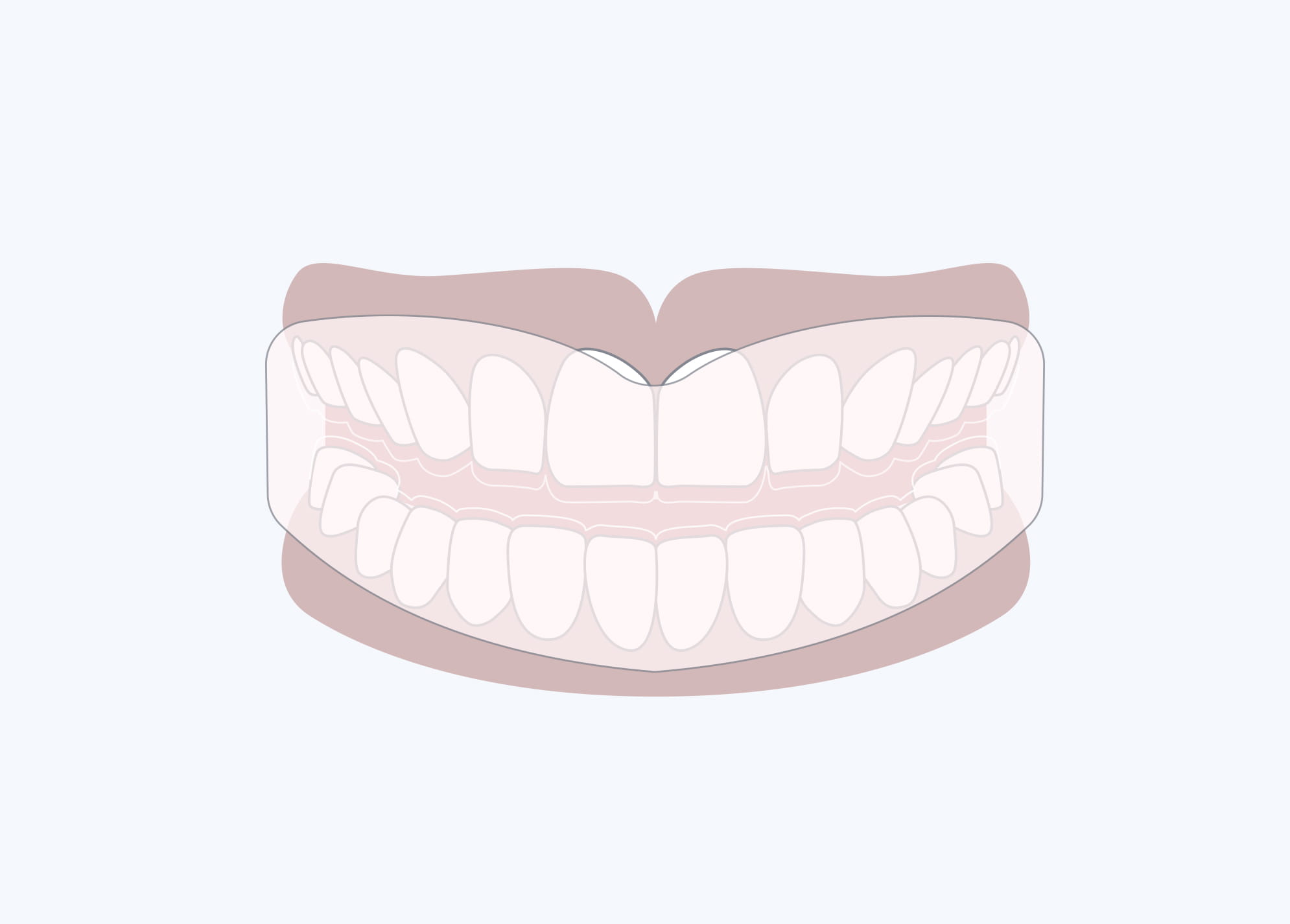 顎を広げ、永久歯に必要なスペースを与える