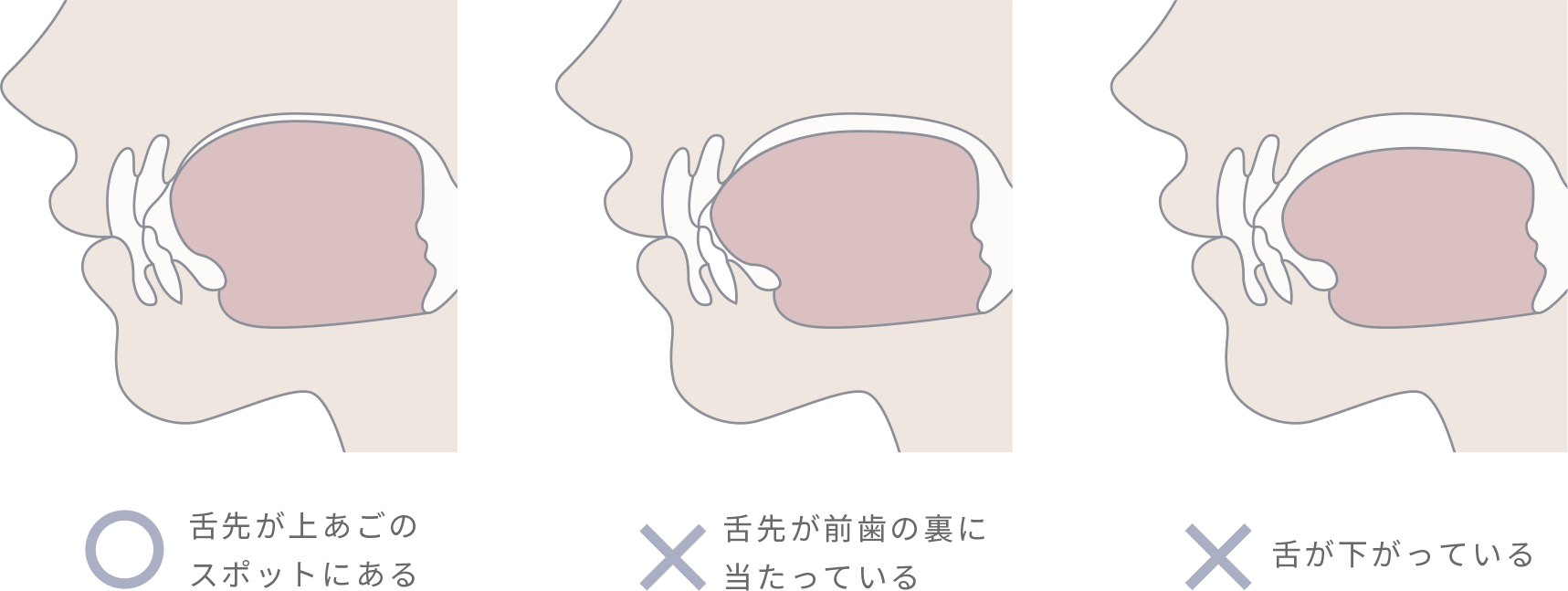 舌を上あごの「スポット」に収めるトレーニング