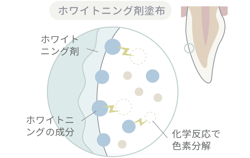外因性変色