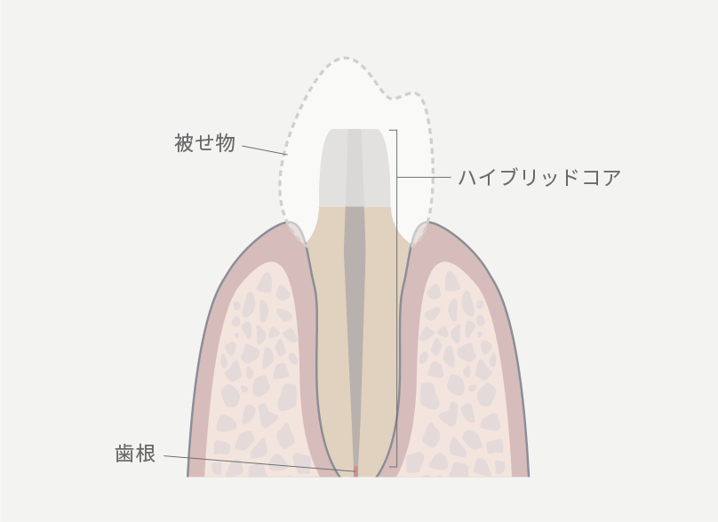 歯の根を補強するハイブリッドコア