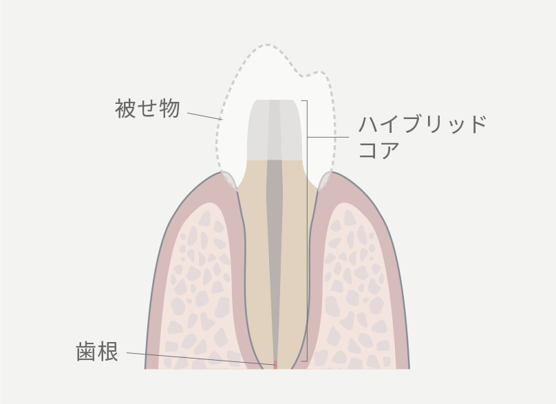 歯の根を補強するハイブリッドコア