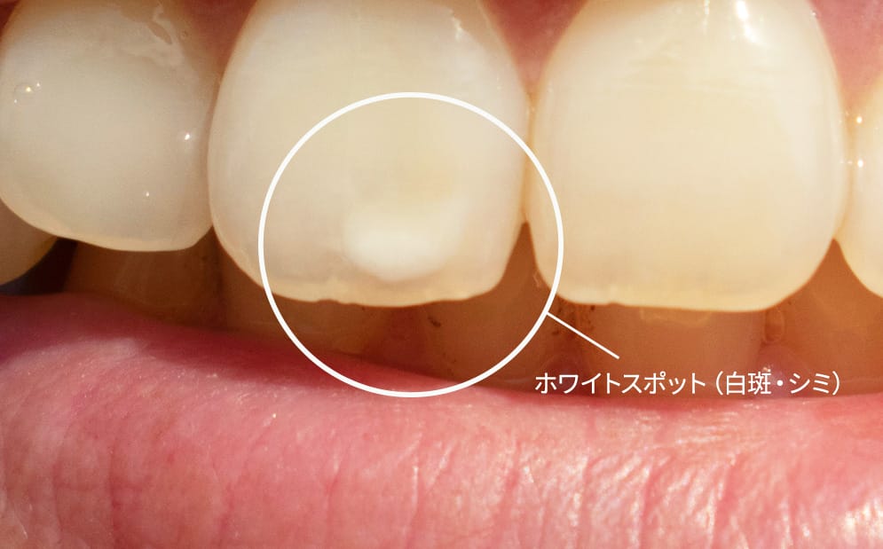 ホワイトスポット（白斑・シミ）とは？