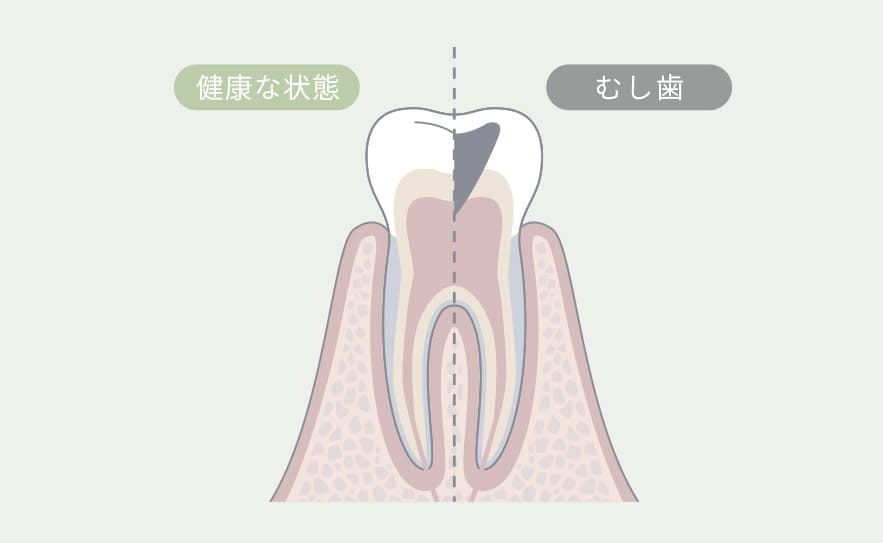 むし歯