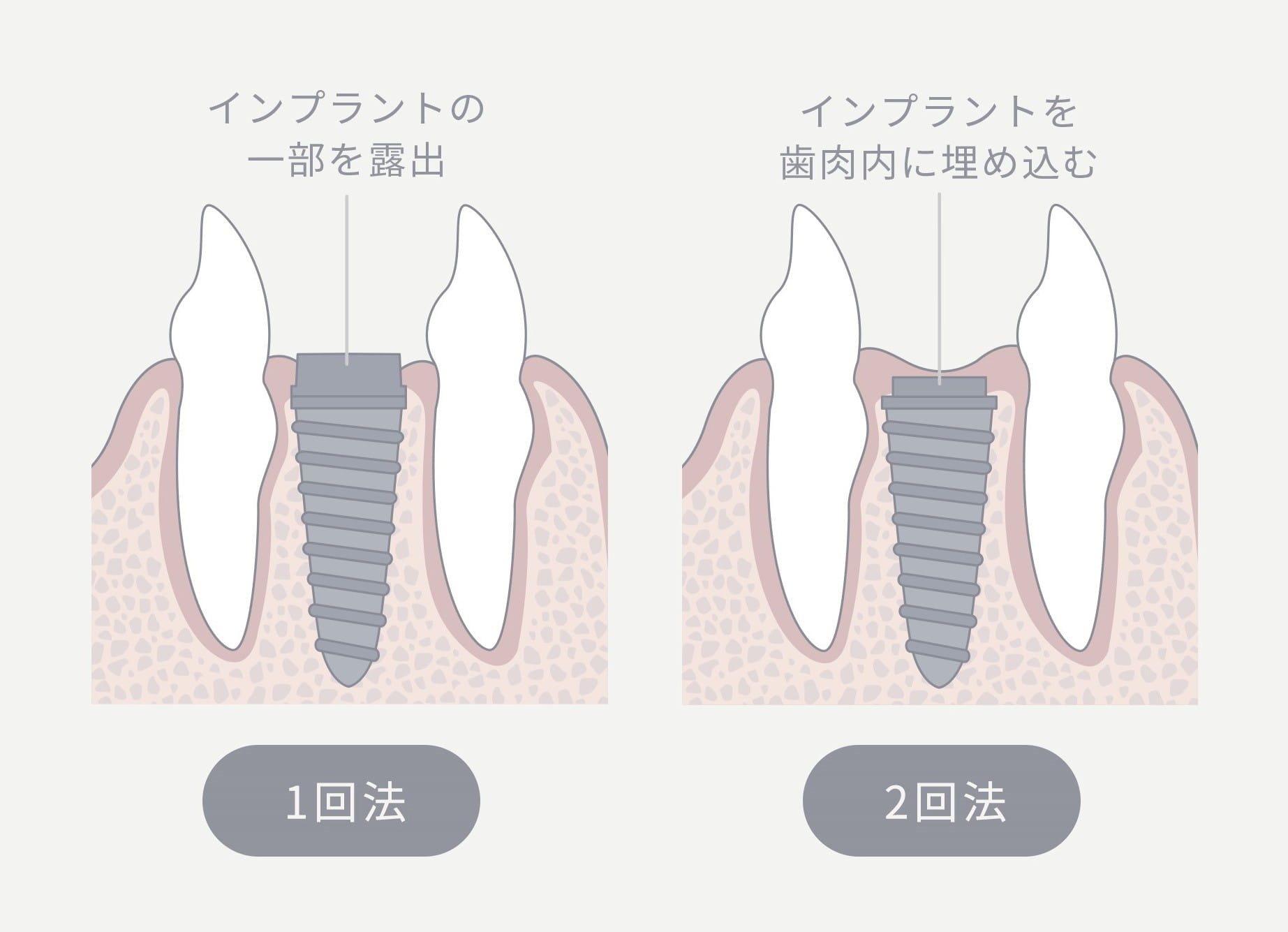 インプラント埋入「1回法」と「2回法」