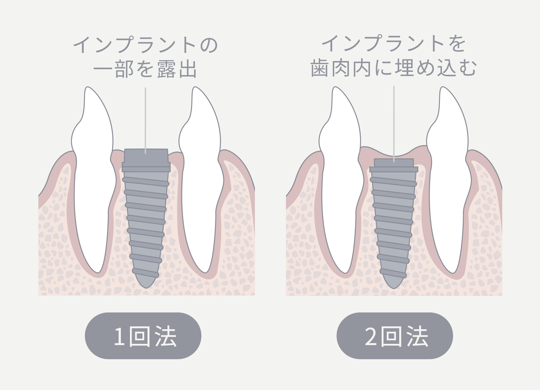 インプラント埋入「1回法」と「2回法」